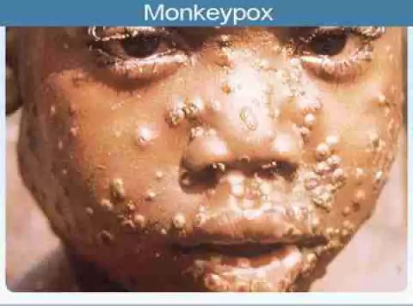 Six More Cases Of Monkeypox Confirmed In Nigeria (See Affected States)